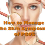 How to Manage the Skin Symptoms of PCOS